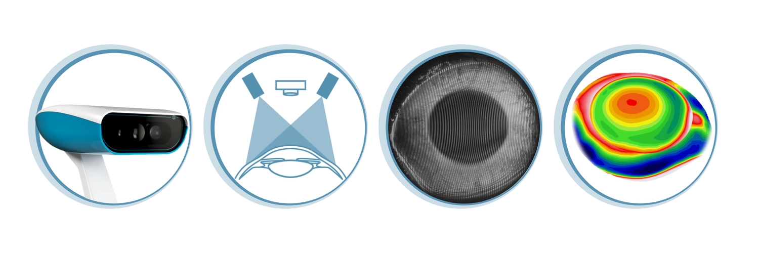 Kontaktlinsen Schmid - Kontaktlinsenspezialist und Sehtherapie - Eine Illustration zeigt vier kreisförmige Symbole, die den Prozess der Scheimpflug-Bildgebung für die Augendiagnostik darstellen. Die Sequenz umfasst die Spezialkamera, ein Diagramm der die Hornhaut abtastenden Lichtstrahlen, ein unbearbeitetes Schwarz-Weiß-Scheimpflug-Bild des vorderen Augenabschnitts und eine finale, farbcodierte Hornhauttopographiekarte.